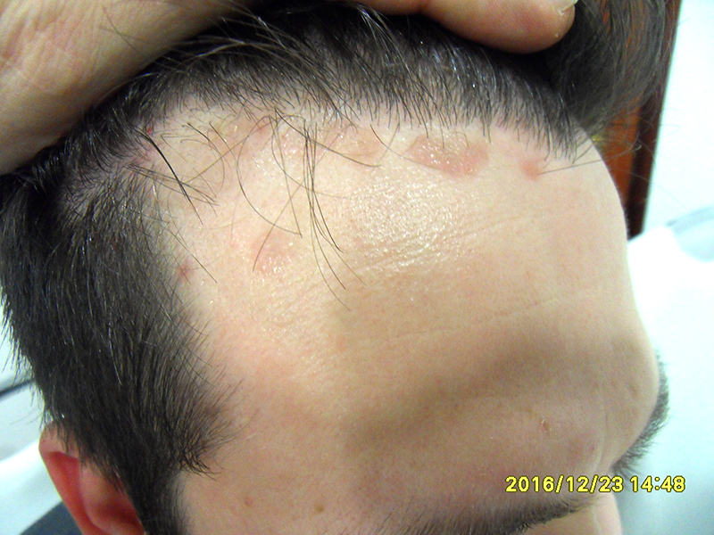 Mikor jelezhet betegséget a viszkető fejbőr? - EgészségKalauz