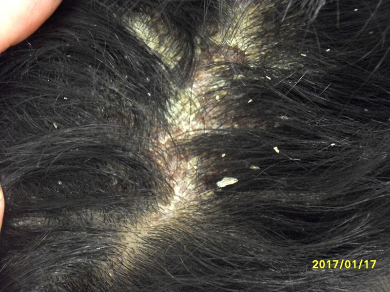 Pikkelysömörös fejbőr kezelése, ápolása