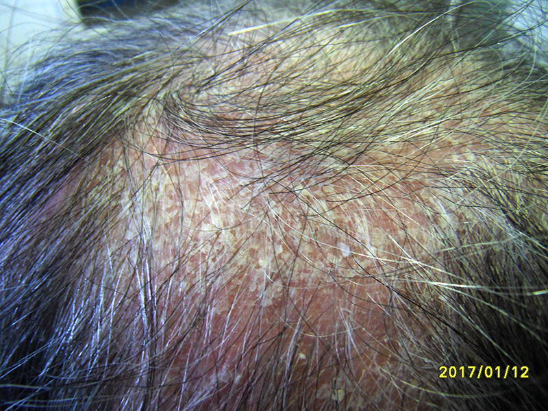 fejbőr betegségei a bőrön lévő folt vörös peremekkel pelyhez és viszket