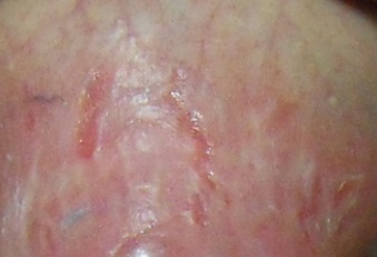Bőr és nyálkahártya candida-fertőzése tünetei és kezelése